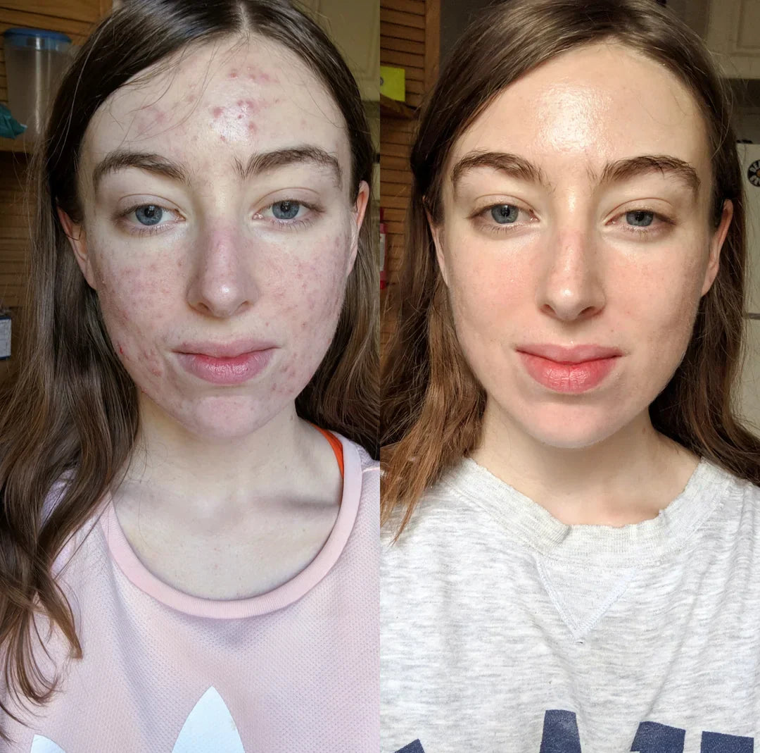 New Formula Hormonal Acne Supplement