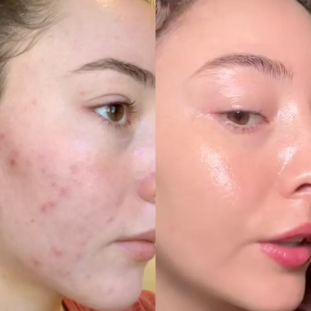 New Formula Hormonal Acne Supplement