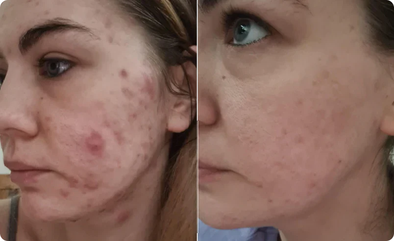 New Formula Hormonal Acne Supplement